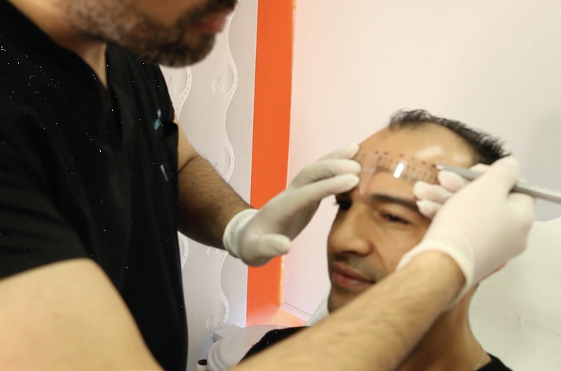 HAIR TRANSPLANT PACKAGE – ISTANBUL